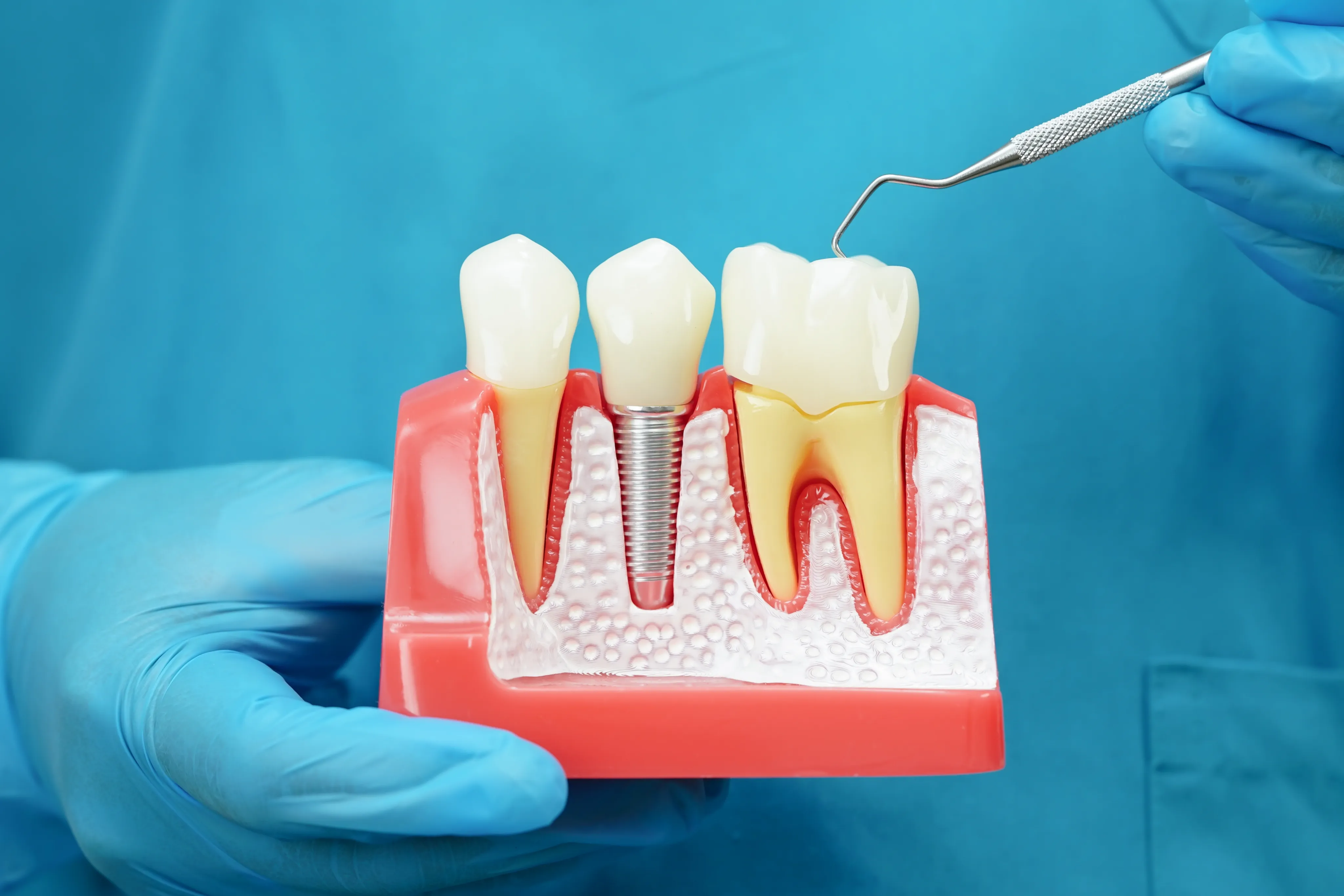Dental Implants